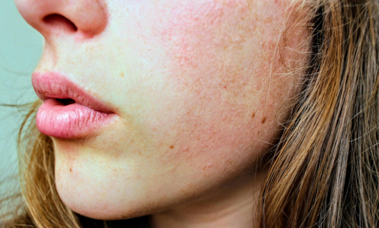 5 Causes of Dry Skin and Hair
